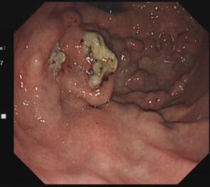食管胃底静脉曲张症状图片