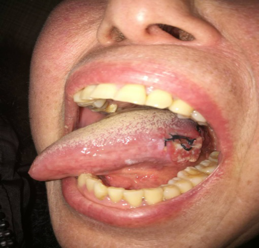 癌症舌头图片