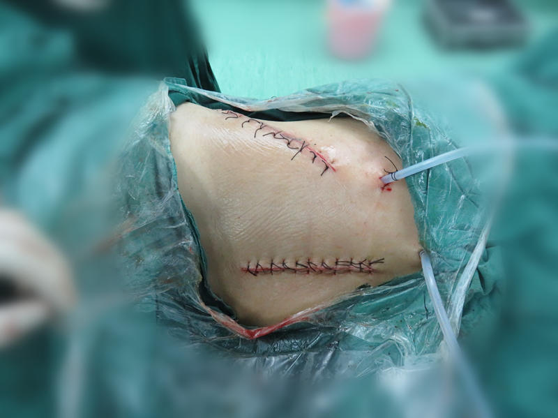 大骨瓣减压手术切口图图片